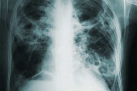 肺部纤维化(肺部纤维化的原因和治疗方法)